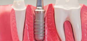 Będzie implant przyśpieszający osteointegrację?