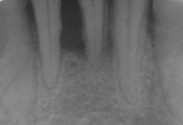 Bakterie powodujące periodontitis odpowiedzialne za choroby serca (źródło: wikipedia.org) Bakterie powodujące periodontitis odpowiedzialne za choroby serca