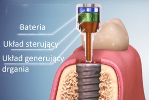 Osteointegracja przyspiesza przy drgającym implancie Implanty: impulsy elektromagnetyczne wzmacniają osteointegrację