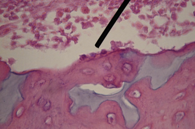 Osteoblasty (na przedłużeniu strzałki) (fot. wikipedia) Zastrzyki zamiast chirurgii