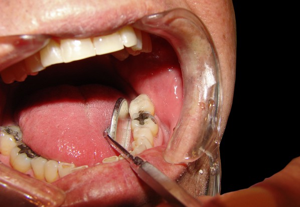 Leczenie endodontyczne a refundacja (fot. sxc.hu)