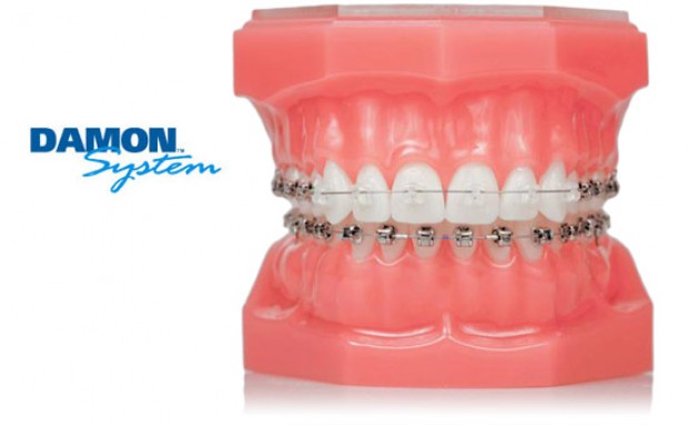 Ortodoncja: teraz Damon jest Smile (fot. Orco) Ortodoncja: teraz Damon jest Smile (fot. Orco)