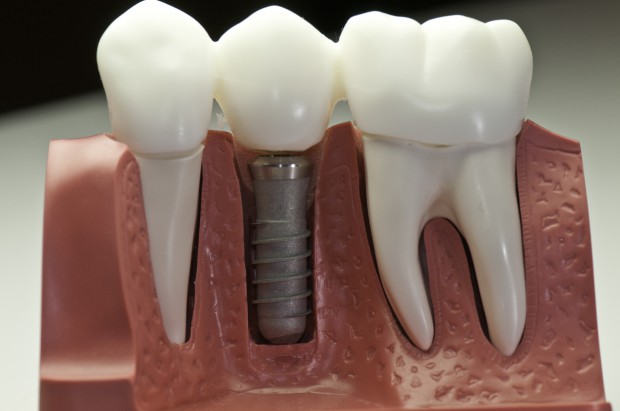 Naukowcy z Białegostoku pracują nad implantami stomatologicznymi (fot. Fotolia/PTWP) Naukowcy z Białegostoku pracują nad implantami stomatologicznymi (fot. Fotolia/PTWP)