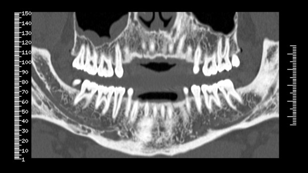 Dentascan w szpitalu uniwersyteckim w Bydgoszczy (Fot. GE Healtcare) Dentascan w szpitalu uniwersyteckim w Bydgoszczy