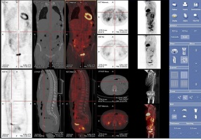 Problemy z obrazowaniem PET/MRI. Będzie przełom.