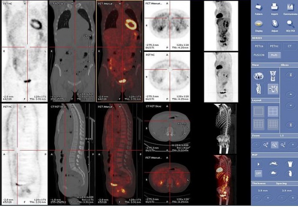 foto: Obrazowanie PET MRI: kręgosłup i organy wewnętrzne (źródło: Wikipedia) Problemy z obrazowaniem PET/MRI. Będzie przełom.
