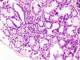 PeriRx – przełom w diagnozie Zespołu Sjögrena w rękach stomatologów