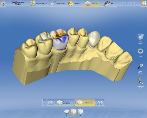 Software CERECA jeszcze lepszy (fot. Sirona) Software CEREC jeszcze lepszy