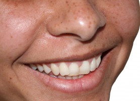 UE: dentyści raportują o niepożądanych efektach wybielania zębów