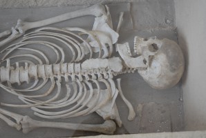 Dziecko z wrodzoną kiłą – historyczna żuchwa prawdę powie