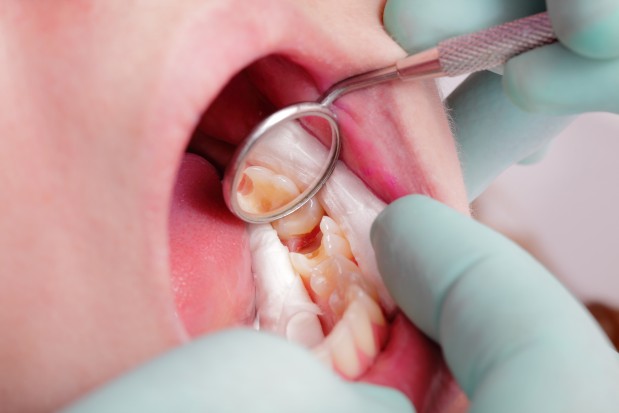 Działania projektu skupiają się na metaloproteinazie macierzy 8 (MMP-8) (fot. Fotolia/PTWP) Guma do żucia umożliwi moniotorowanie implantów