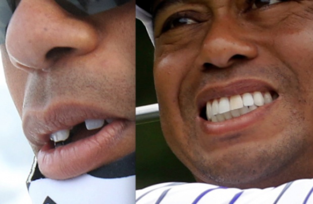 Taki brak w uzębieniu mistrza nie mógł nie paść ofiarą fotoreporterów Jak Tiger Woods stracił „jedynkę”