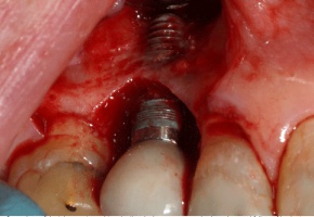 Implant musi być kontrolowany (foto: wikimedia) Obserwujcie implanty!