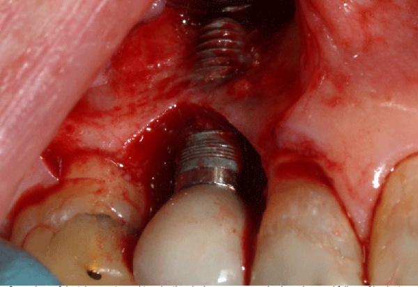 Implant musi być kontrolowany (foto: wikimedia) Obserwujcie implanty!
