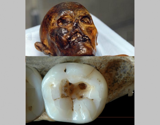 Robota dentysty sprzed 14 tys. lat Zęby leczone ostrymi kamieniami