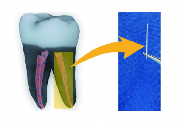 Obraz 3D zęba wypełnionego materiałem wzmocnionym nanodiamentami Nanodiamenty dają mocny impuls w leczeniu kanałowym