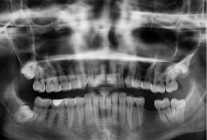 Rtg u dentysty (foto: pixabay) Promieniowanie jonizujące w gabinecie dentystycznym: czas rozstrzygnięć