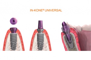 Implanty w systemie In-Kone Global D: implanty w systemie In-Kone