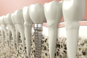 Implanty a peri-implantitis Implanty a peri-implantitis: jaka korelacja?