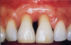 PTP coraz bardziej aktywne (źródło: Wikipedia) Polskie Towarzystwo Periodontologiczne: szkoli, popularyzuje i...