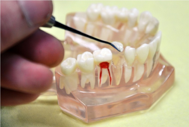 Dentysto uważaj na bisfenol A Dentysto, uważaj na bisfenol A w materiałach stomatologicznych