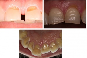 Erozja, jak z nią walczyć (źródło: Instytut Blend-a-Med Oral-B) European Federation of Conservative Dentistry o erozyjnym ścieraniu zębów