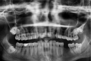 Rentgenodiagnostyka w ocenie RP AOTMiT (foto: pixabay) Rentgenodiagnostyka do pięciu zdjęć wewnątrzustnych jako świadczenie gwarantowane