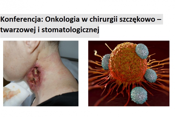 Onkologia w chirurgii szczękowo – twarzowej i stomatologicznej Onkologia w chirurgii szczękowo – twarzowej i stomatologicznej