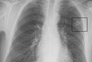 Paradontoza zwiększa ryzyko raka płuca