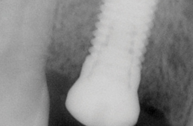 Dobry pomysł na propagowanie leczenia - miesiąc implantu dentystycznego Sierpień miesiącem implantu