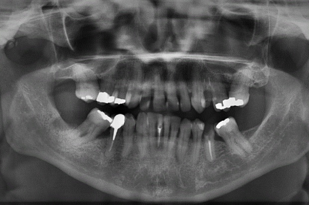 Zdjęcia rtg zlecane zbyt często? (foto: pixabay) Dentyści zbyt często zlecają zdjęcia rtg