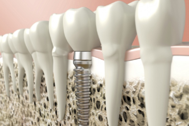 Co czwarty pacjent decydujący się na wszczepienie implantów uzupełnia brak jednego zęba Implanty coraz popularniejsze