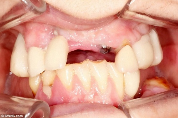 Straciła zęby, pieniądze i zdrowie Straciła majątek, pracę i zdrowie, bo poszła do dentysty