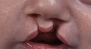 Naukowcy: wiemy więcej o stomatologicznych problemach dzieci z rozszczepem wargi i podniebienia