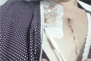 Helen Bolton po operacji Czekała na dentystę niemal dwa lata i niemal umarła