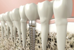 Nie ustają poszukiwania metod poprawiających przyjmowanie się implantów (fot. pixabay) Peptydy