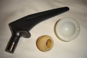 Endoproteza stawu biodrowego (źródło: Wikipedia) ADA o pacjentach z protezą stawu biodrowego