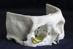 Wykorzystując implant 3D odtworzono dolną, przyśrodkową ścianę oraz kostne brzegi oczodołu (fot. GUMed) Nowatorski zabieg rekonstrukcji oczodołu z udziałem stomatologa z GUMed