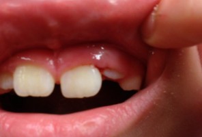 Płock: konkurs NFZ uniemożliwia powrót dentystów do szkół!