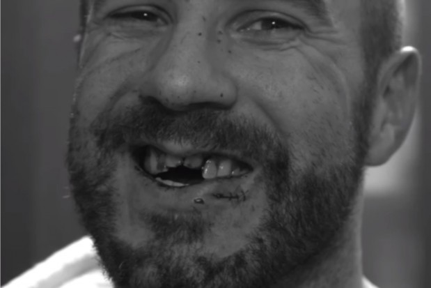 Cesaro (Claudio Castagnoli) tuż po urazie przednich zębów (fot. Instagram) Pytanie na Instagramie: szukam dobrego dentysty