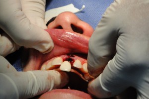 Implanty się nie sprawdziły (foto: pixabay) Pacjent za implanty zapłacił 5 tys. zł, chciał od dentystki dziesięć razy tyle