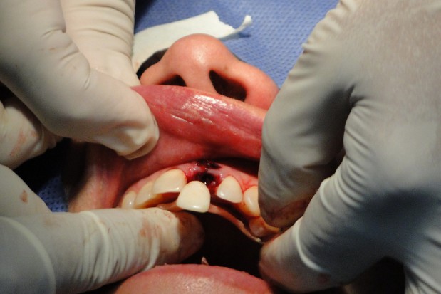 Implanty się nie sprawdziły (foto: pixabay) Pacjent za implanty zapłacił 5 tys. zł, chciał od dentystki dziesięć razy tyle