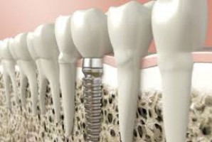 Trwają badania nad opracowaniem materiału, który w implantologii zastąpi tytan (fot. pixabay) Jak nie tytanowy implant to jaki?
