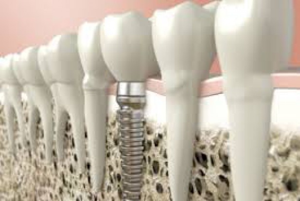 Trwają badania nad opracowaniem materiału, który w implantologii zastąpi tytan (fot. pixabay) Jak nie tytanowy implant to jaki?