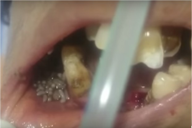 Larwy w ustach pacjentki Praca dentysty mrozi krew w żyłach