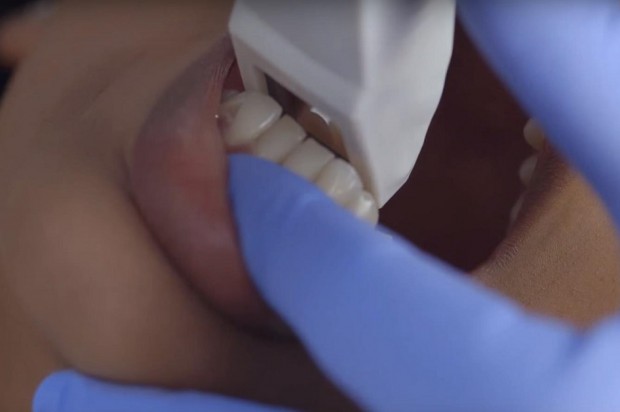 Pobieranie wycisku 3D przy pomocy skanera (fot. Dentim Clinic) Skanery wewnątrzustne prą naprzód