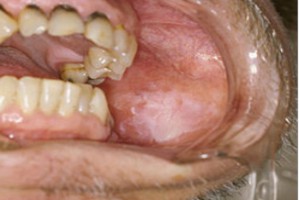 Leukoplakia (fot. Wikipedia) Rak jamy ustnej - nowotwór pobakteryjny?