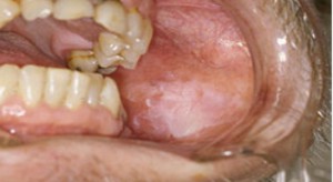 Rak jamy ustnej - nowotwór pobakteryjny?