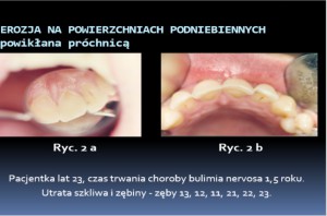 Obraz kliniczny erozji u pacjentki z bulimią (fot. Elżbieta Paszyńska) Przychodzi anorektyczka do dentysty