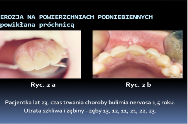 Obraz kliniczny erozji u pacjentki z bulimią (fot. Elżbieta Paszyńska) Przychodzi anorektyczka do dentysty